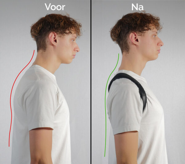 voor en na resultaat van het gebruik van een houding corrector voor de slechte houding onder jongeren